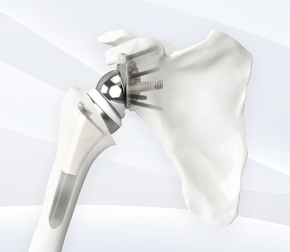 Shoulder Replacement Implants and Anatomical Systems